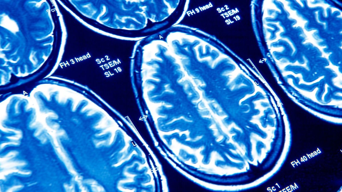 Covid může vést k příznakům podobným Alzheimerově nemoci, varují vědci